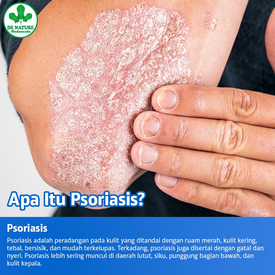 Psoriasis PAKET OBAT EKSIM / EXIM / GATAL KULIT & BISUL
