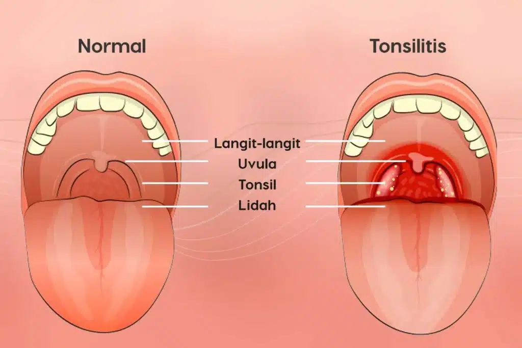 Gejala Amandel yang Umum 1 Gejala Amandel yang Umum