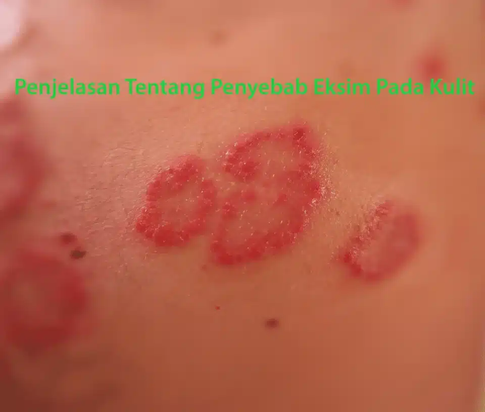 Gejala Eksim Kulit yang Umum 1 Gejala Eksim Kulit yang Umum