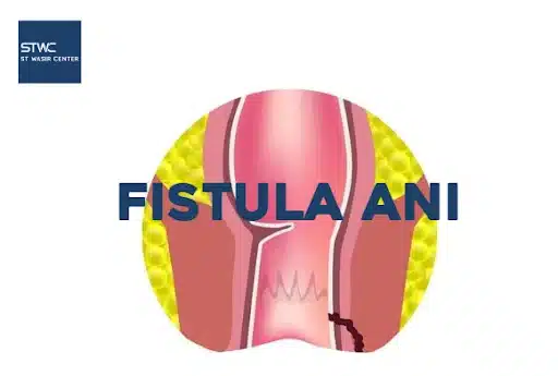 Gejala Fistula Ani yang Perlu Diwaspadai 1 Gejala Fistula Ani yang Perlu Diwaspadai