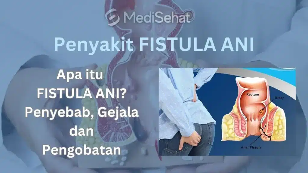 Gejala Fistula Ani yang Perlu Diwaspadai 2 Penanganan Gejala Fistula Ani