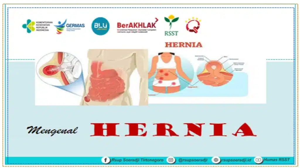 Pengertian dan Jenis Hernia 1 Pengertian dan Jenis Hernia