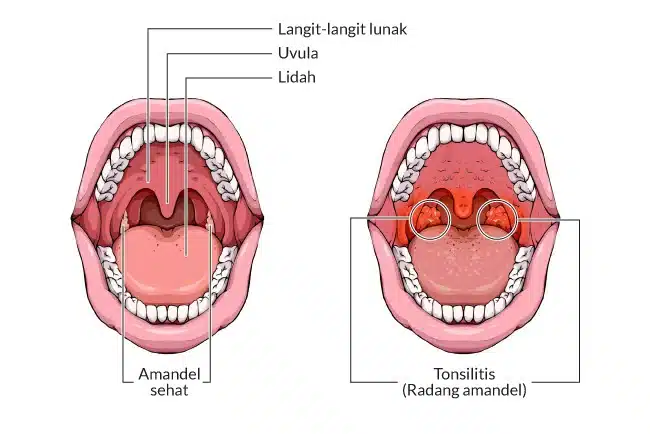 Gejala Amandel yang Umum 2 Pengobatan Gejala Amandel