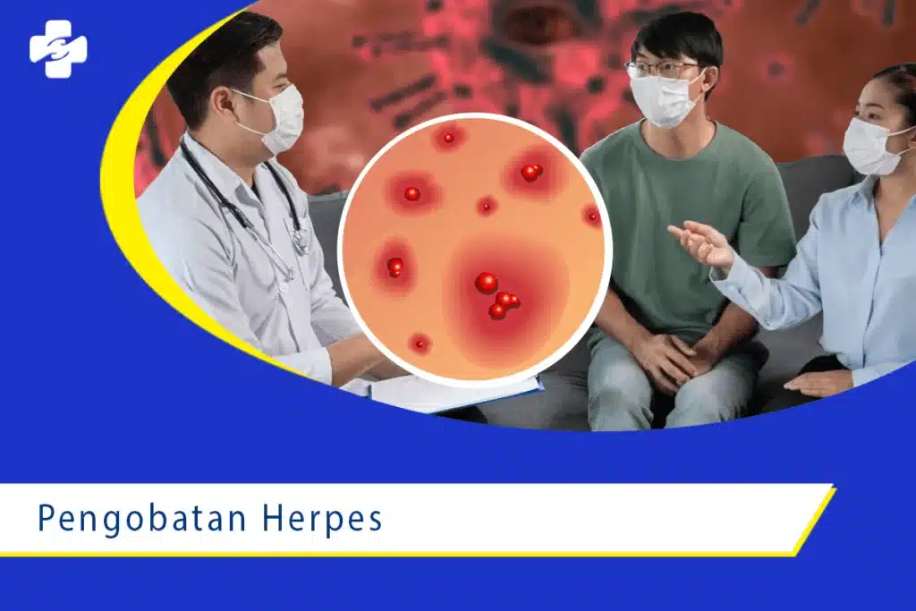 Penyakit Herpes: Gejala, Penyebab, dan Pengobatan 2 Pengobatan Penyakit Herpes