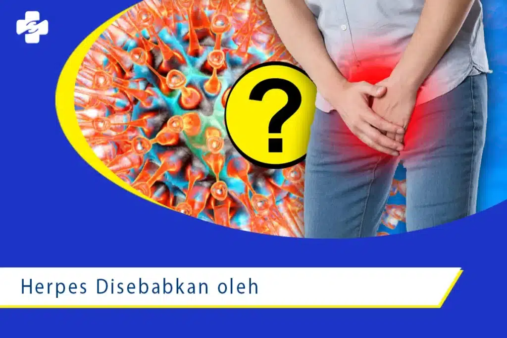 Penyakit Herpes: Gejala, Penyebab, dan Pengobatan 1 Penyebab dan Gejala Penyakit Herpes