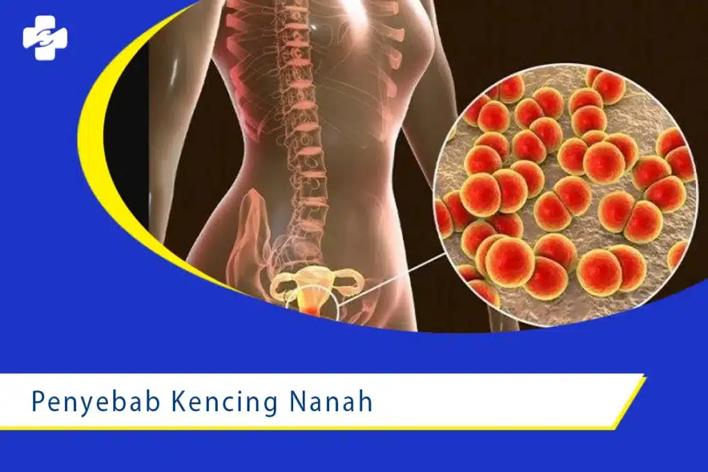 Penyebab dan Gejala Penyakit Kencing Nanah 1 Penyebab dan Gejala Penyakit Kencing Nanah