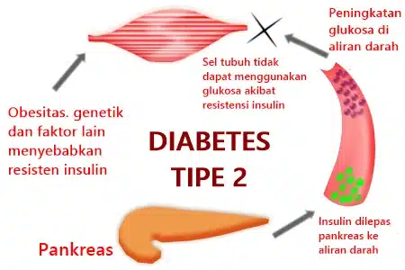 Penyebab Diabetes Tipe 1 2 Penyebab Diabetes Tipe 2