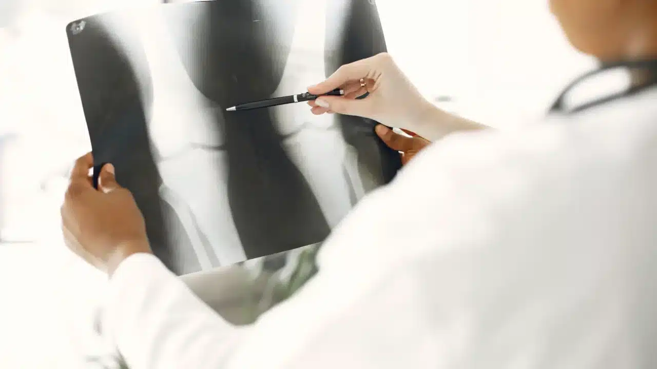 Hemorrhoids Anatomy