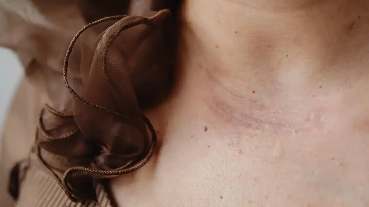 Infertility Scar Tissue