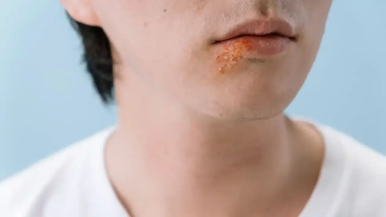 Skin Fungus Skin Condition