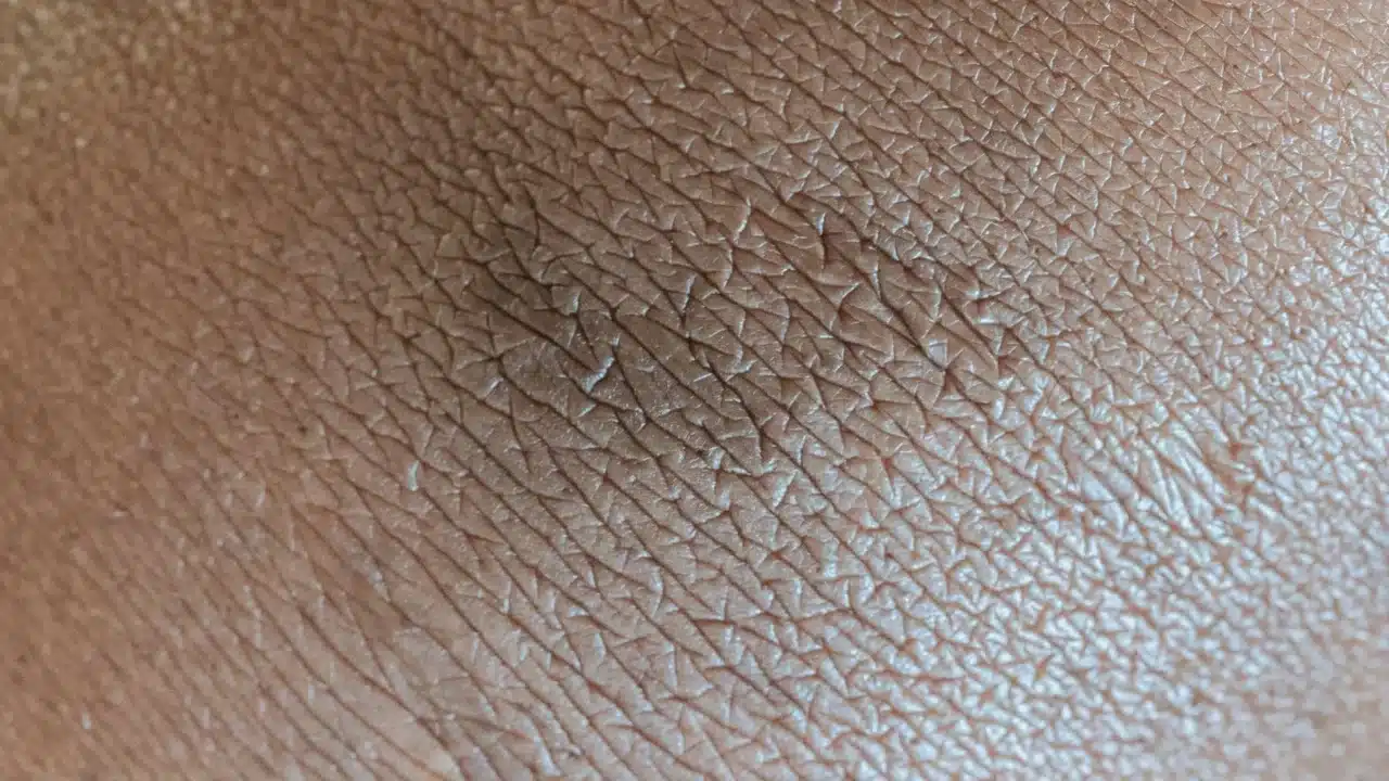 Apa Itu Psoriasis? Gejala, Penyebab, dan Pengobatan Efektif 3 Skin Rash Itchy Skin