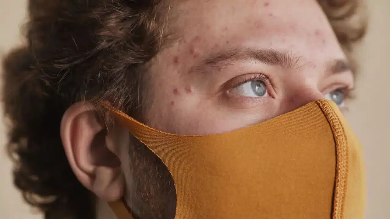 Acne Types Skin Texture