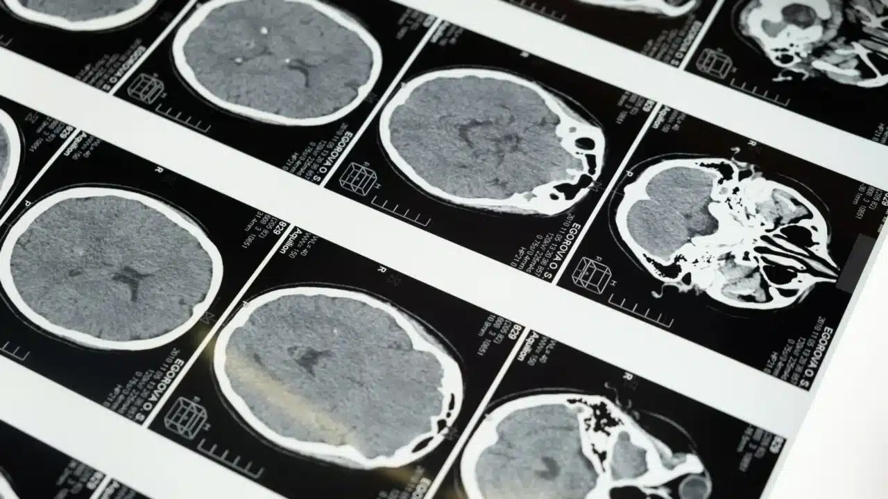 Jenis-jenis Stroke: Pahami Perbedaan & Penanganannya 4 Brain Hemorrhage Bleeding
