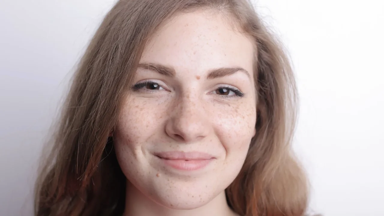 Jenis Bekas Jerawat: Kenali & Cara Mengatasinya 3 Dark Spots Skin Red Spots Face