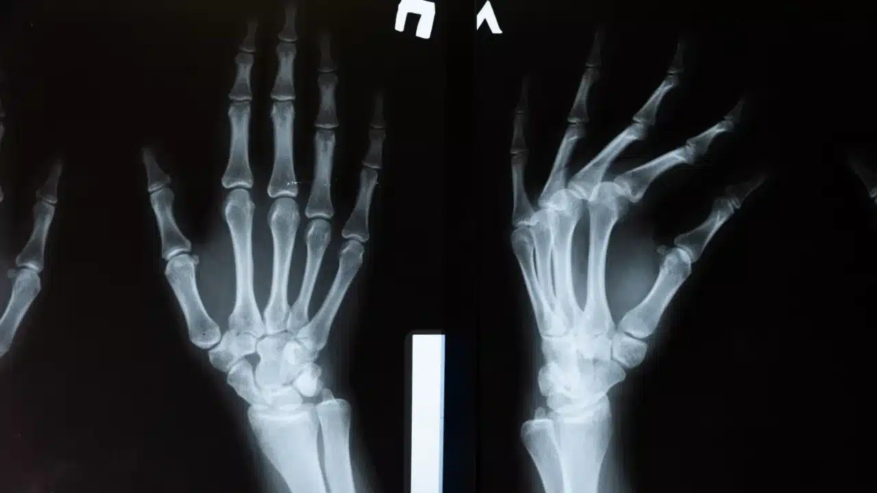 Pegal Linu Tanda Penyakit Apa? Kenali Penyebabnya! 3 Flu Symptoms Joint Pain Bone Scan