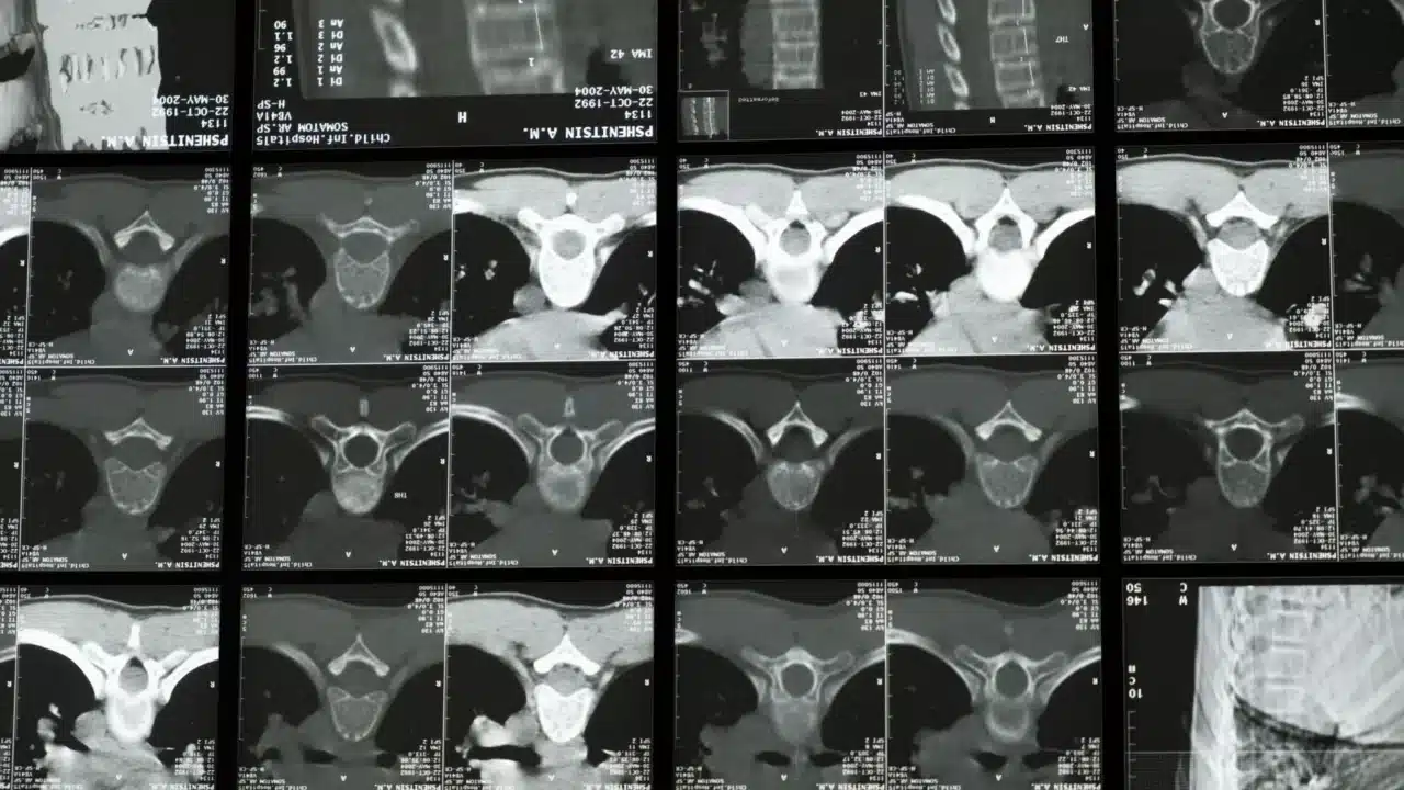 Dampak Minuman Keras Bagi Kesehatan Tubuh 2 Liver Damaged Organ Medical Scan