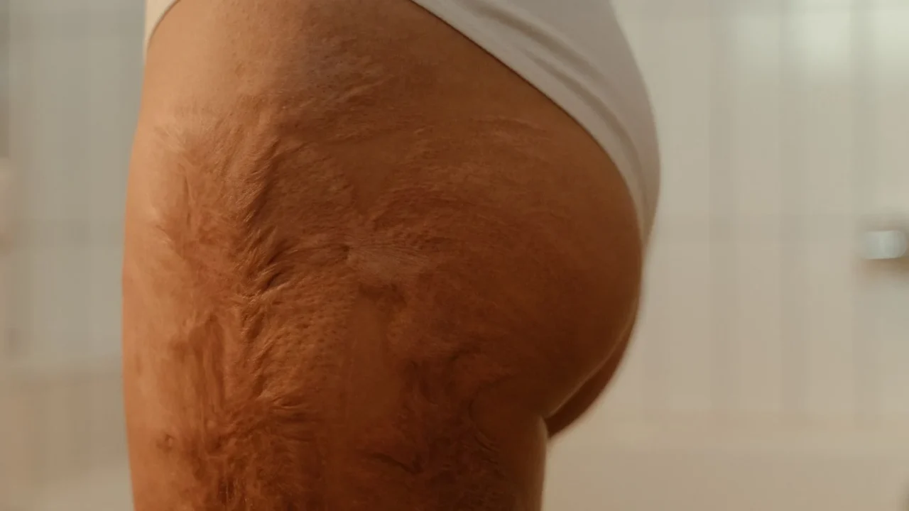 Jenis Bekas Jerawat: Kenali & Cara Mengatasinya 4 Pitted Scars Ice Pick Scars