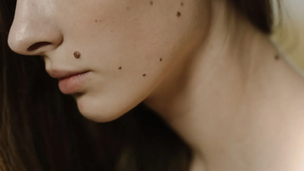 Herpes Genital Adalah: Penyebab, Gejala, dan Pengobatan 3 Rash Skin Lesion