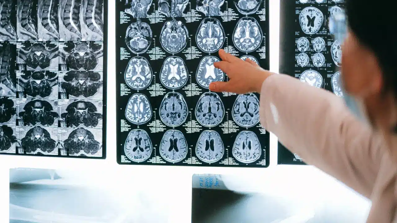 Tanda-tanda Stroke yang Wajib Diwaspadai dan Dikenali 4 doctor consultation senior neurology