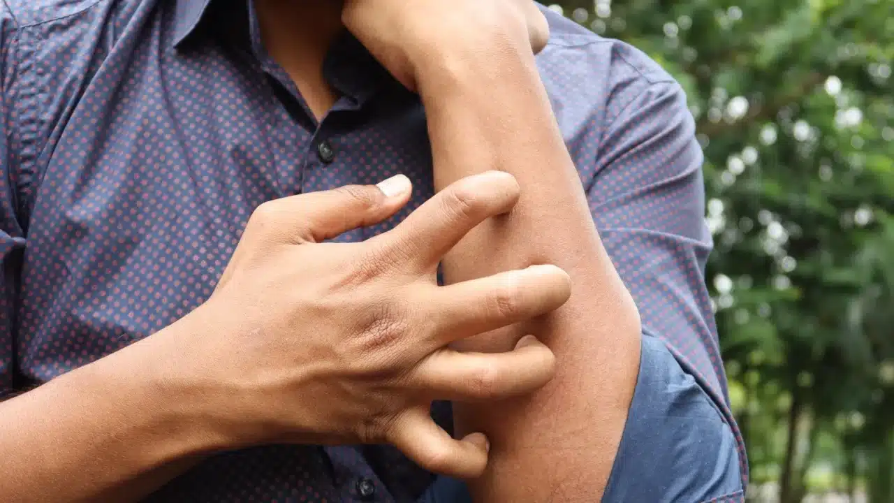 Cara Mengobati Psoriasis: Panduan Medis dan Alami 1 Pengenalan Jenis dan Gejala Psoriasis