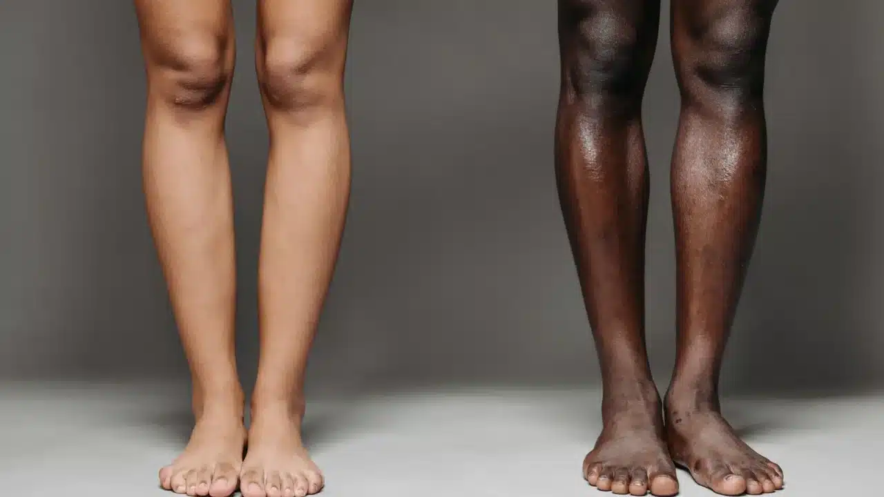 Perbedaan Jengger Ayam & Kutil Kelamin: Kenali & Pahami 3 Skin Comparison Body Parts