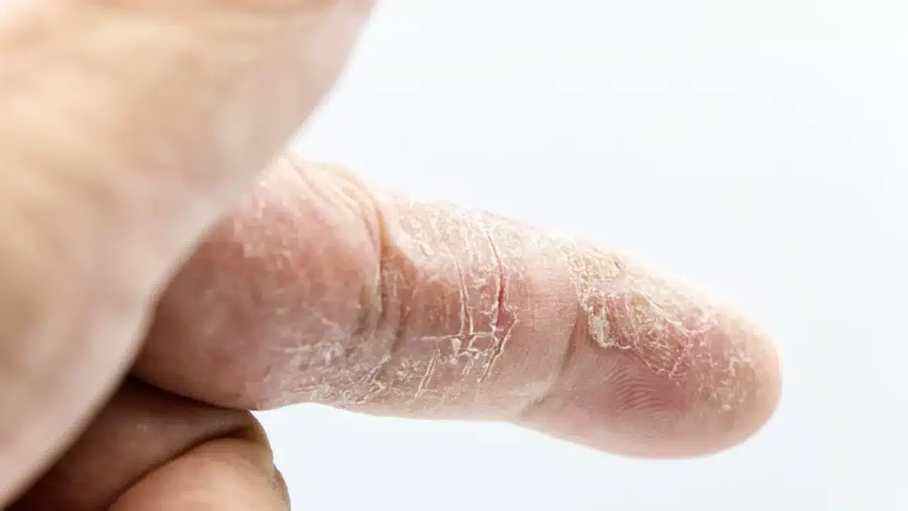 Skin Condition Dry Skin