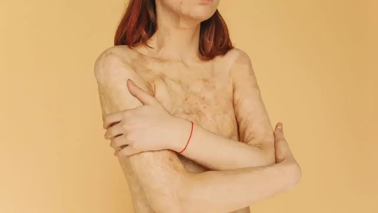 Salep Psoriasis Ampuh: Panduan Lengkap & Rekomendasi Terbaik 1 Skin Condition Psoriasis Patch