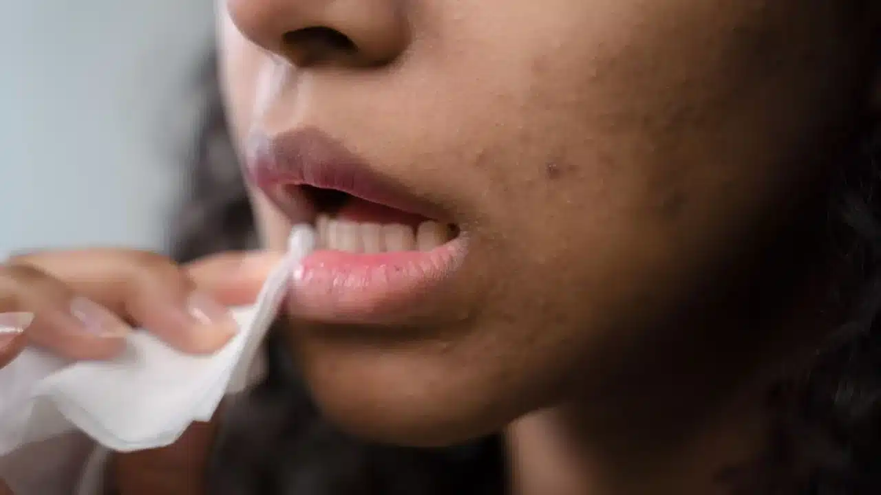 Mengatasi Komedo dan Jerawat: Panduan Lengkap Kulit Bersih 1 Skin Pores Blackhead Whitehead