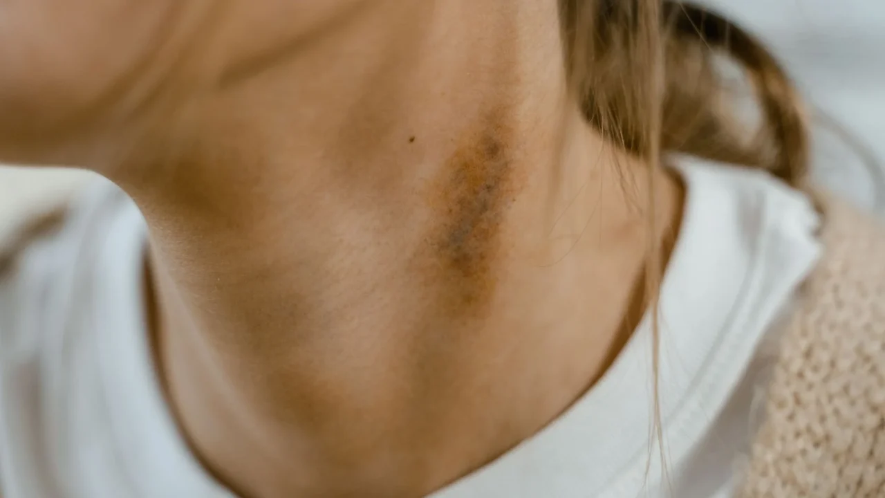 Asam Lambung vs GERD: Perbedaan, Gejala, dan Penanganan 4 throat pain heartburn sensation