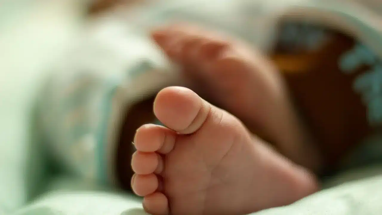 Penyakit Kuning Akibat Hepatitis: Gejala, Penyebab & Pencegahan 1 Yellow Skin Jaundice Baby