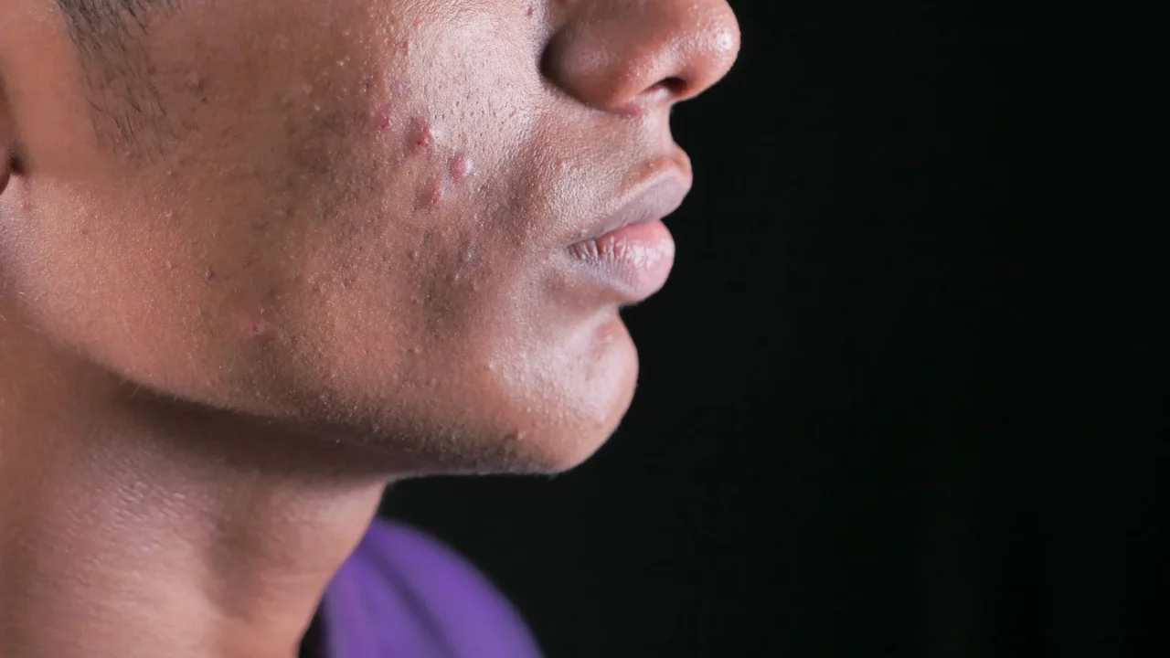 acne papule pimple