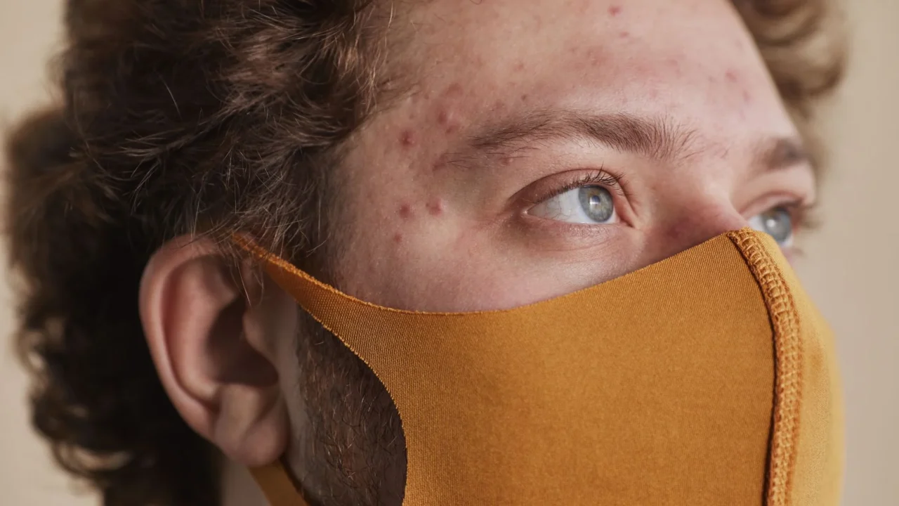cystic acne severe acne